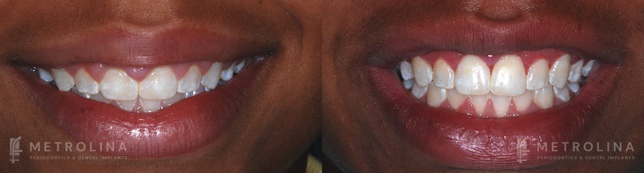 metrolina-periodontics-charlotte-crown-lengthening-patient-1-2-1