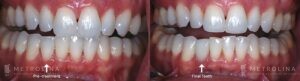 Dental Implants Before and After Patient 2.2