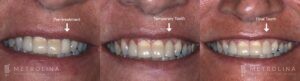Dental Implants Before and After Patient 3.2.1