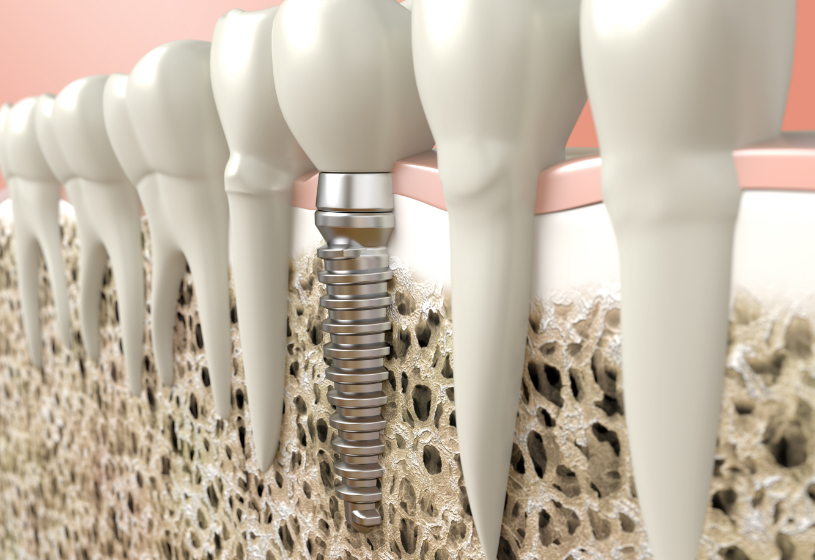 Dental Implant Graphic